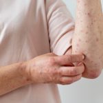 Scabies yang Kerap Dikira Gatal Biasa Sementara itu Menular